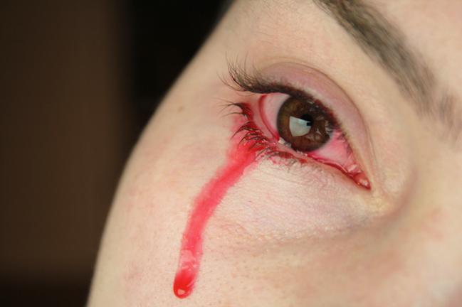 Haemolacria (Bloody Tears) - Anaheim Eye Institute