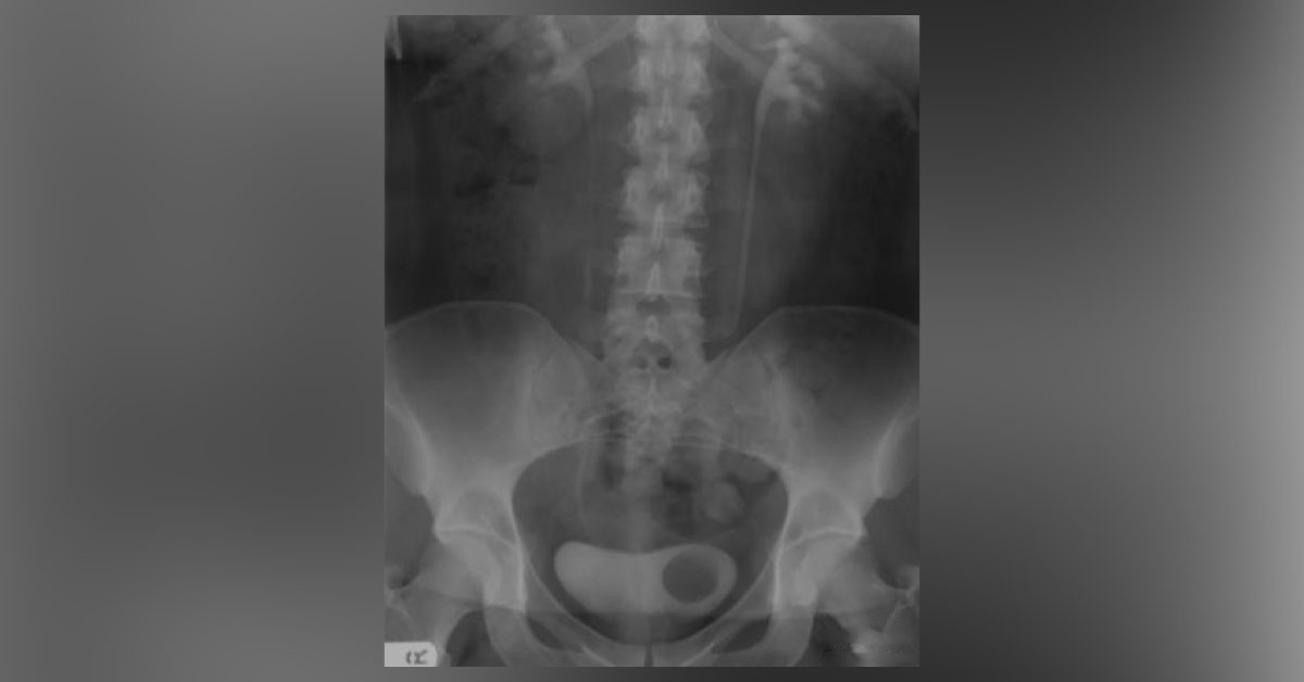 Identify The Cause Of Recurrent UTI