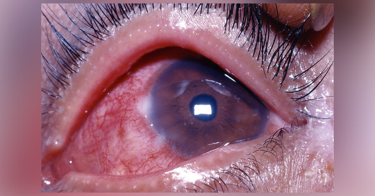 Ocular Manifestation Of Phlyctenulosis