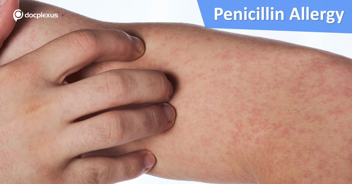 Penicillin Allergy: A Quick Management Guide