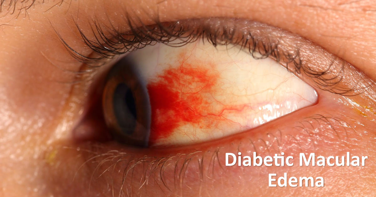 Dexamethasone Does Not Improve Vision in Diabetic Macular Edema