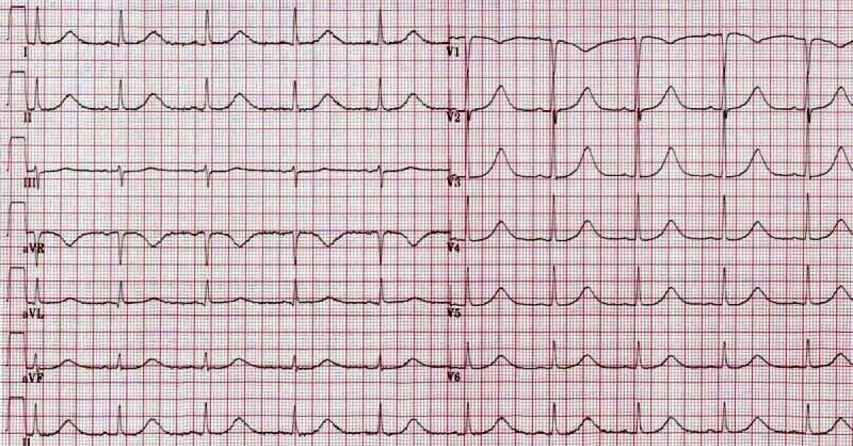 Interpret This ECG