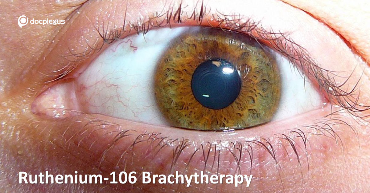 Ruthenium-106 brachytherapy for iris melanomas