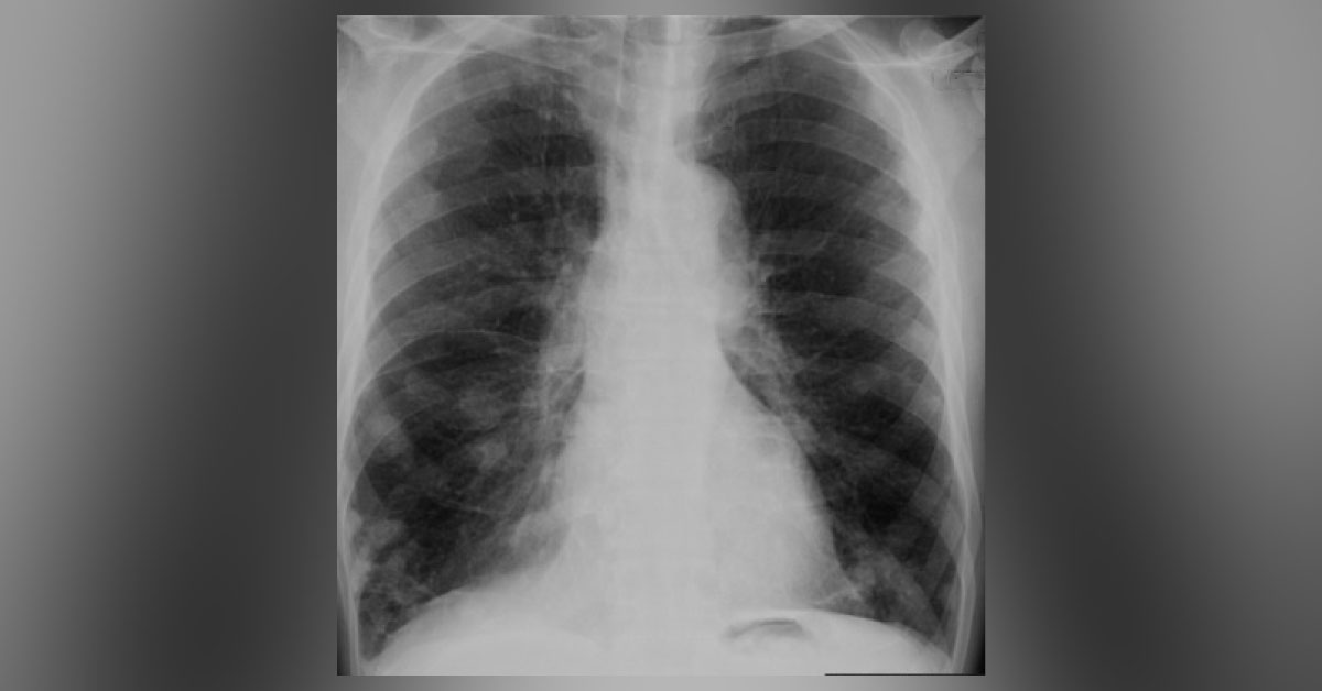 Identify This Pulmonary Disorder