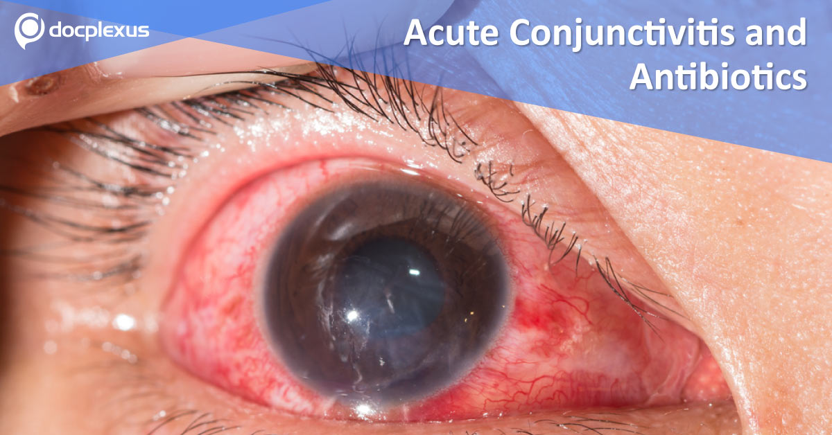 Acute Conjunctivitis And Prescription Of Antibiotics