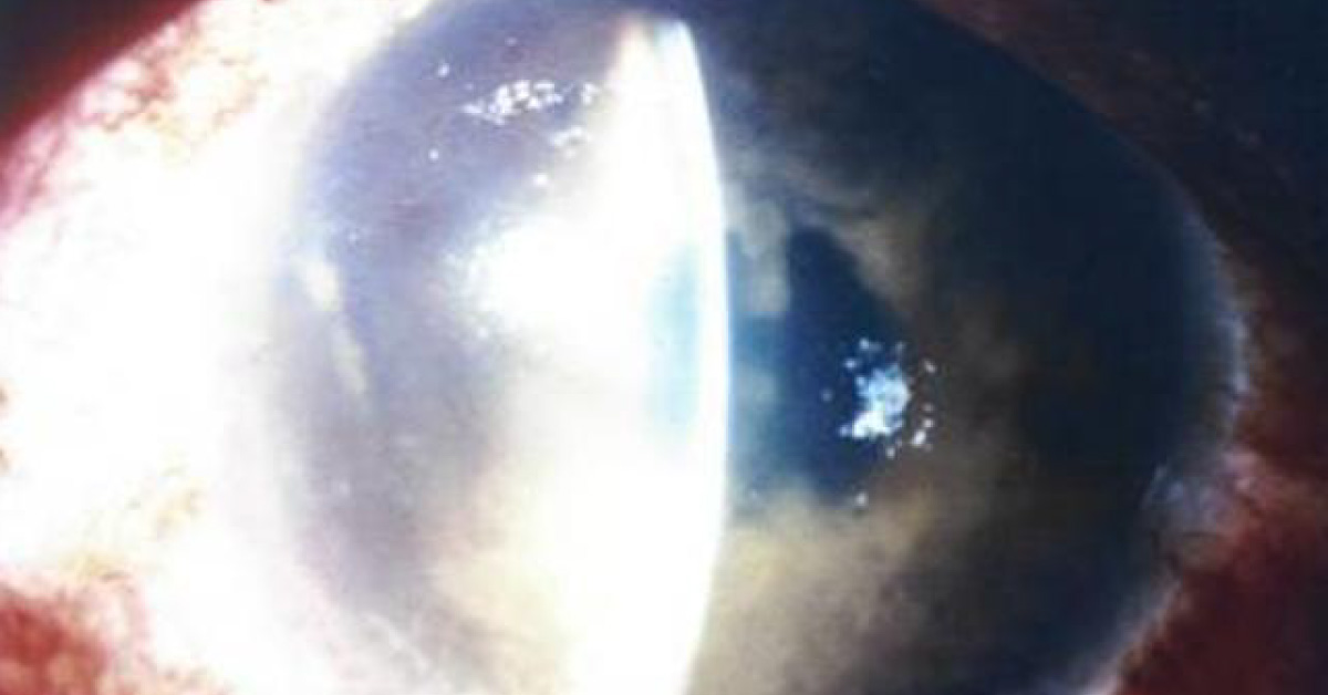 Ocular Manifestations Of Leprosy