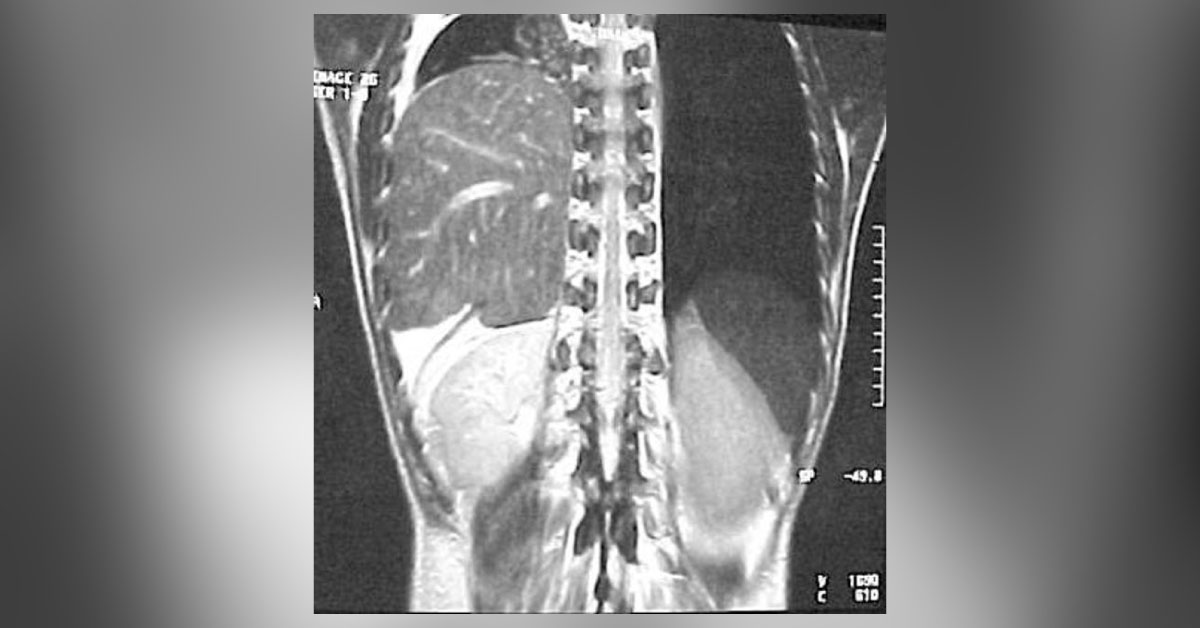 Rupture Of Right Diaphragm