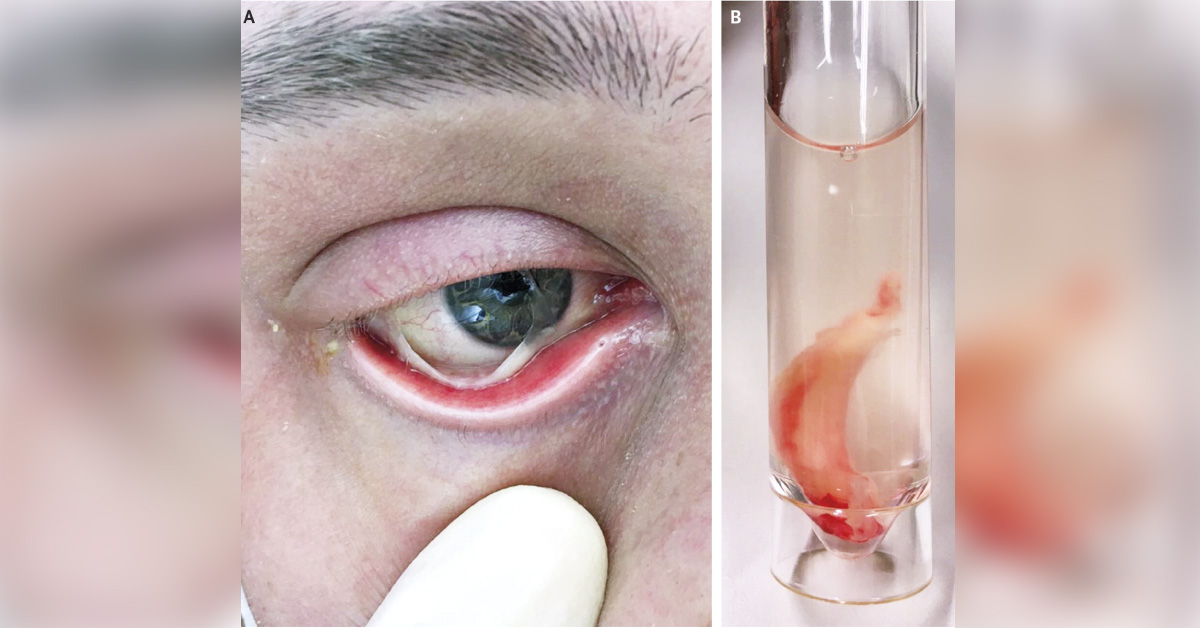 Identify This Ocular Condition