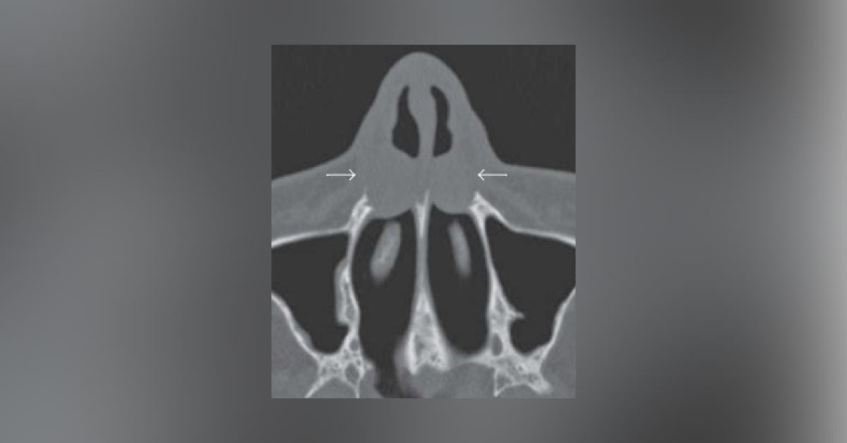 Reason For Nasal Obstruction