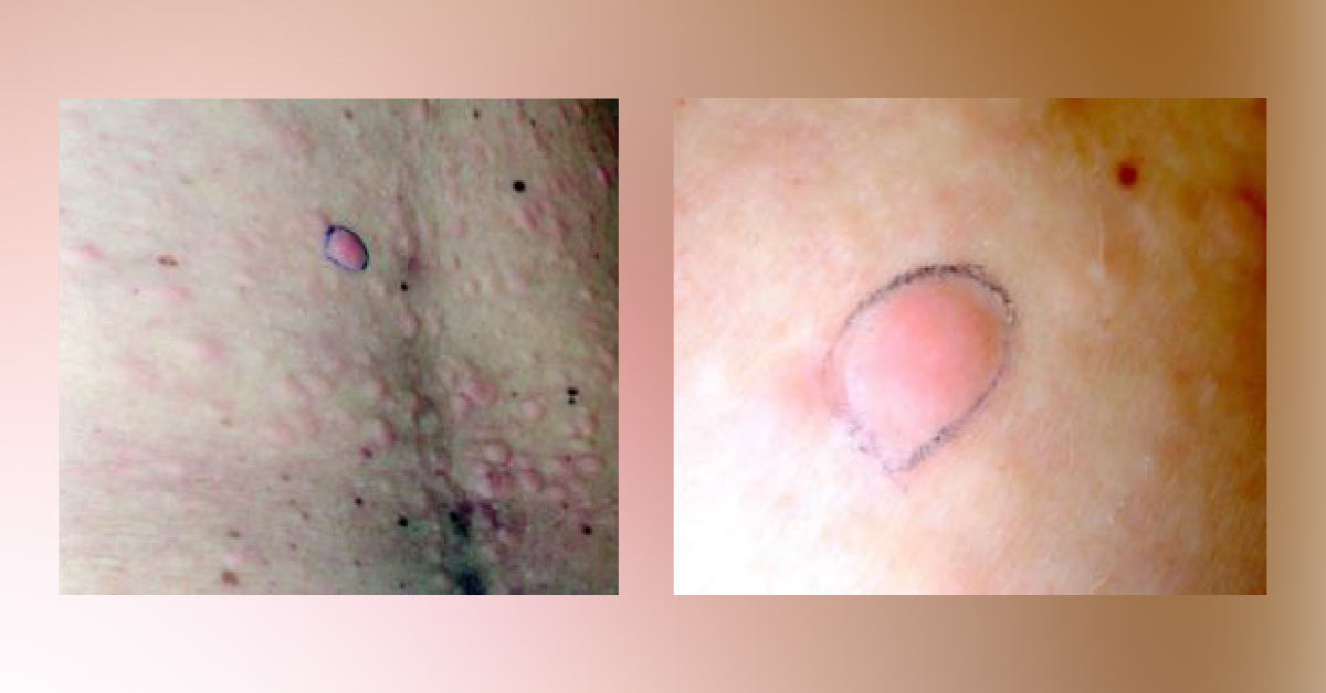 Identify This Dermatology Condition