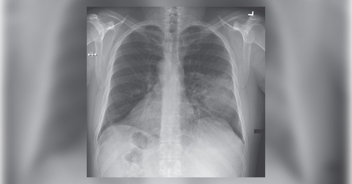 Determine If This Patient Has A Pneumonia