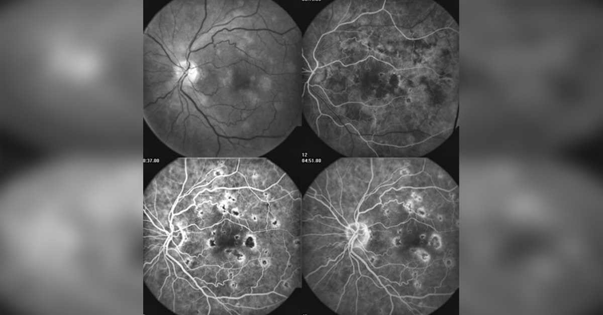 Ocular Manifestations Of Tuberculosis
