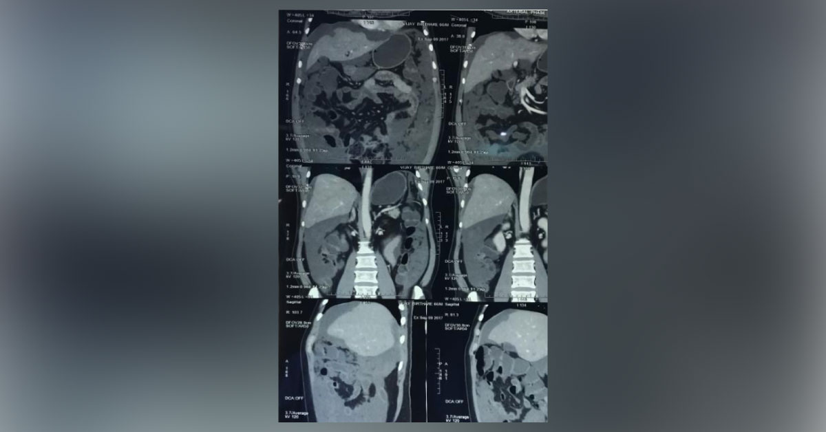 Pseudomyxoma Peritoneii From Appendicular Tumour
