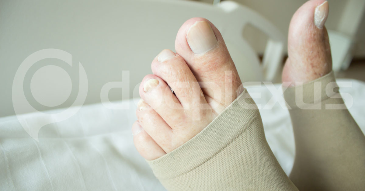 Peri Operative Deep Vein Thrombosis