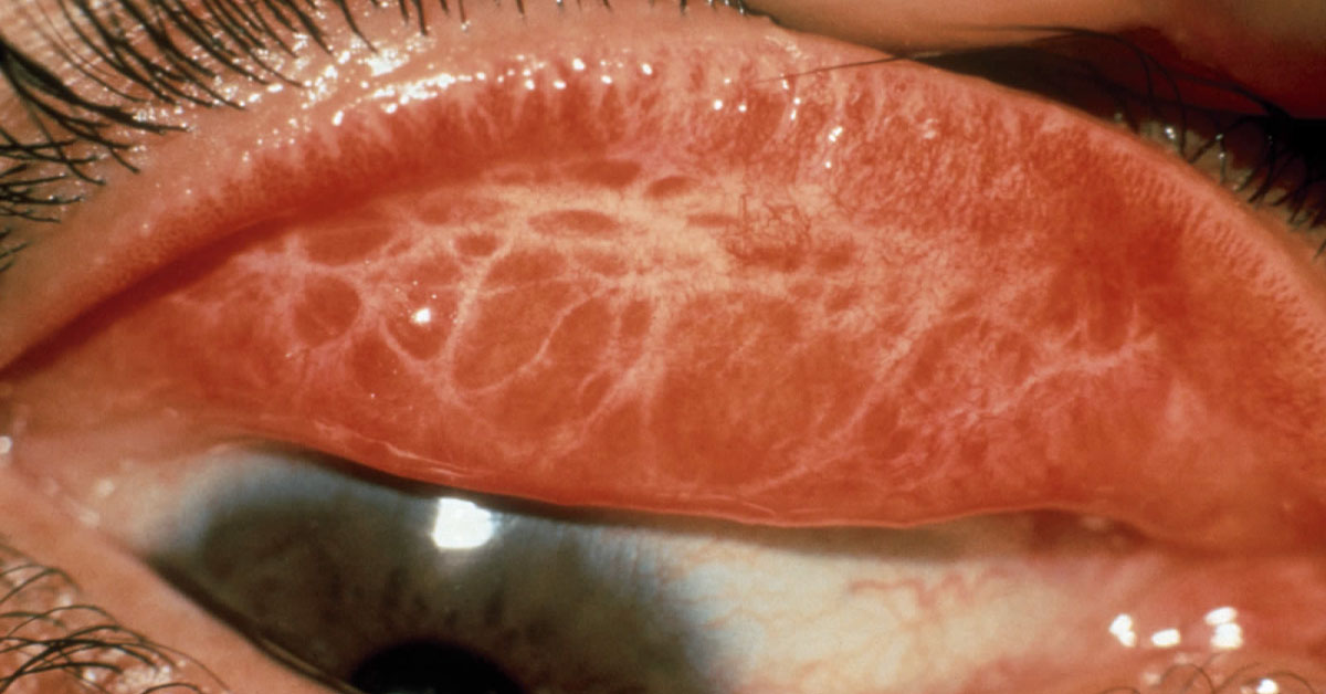 Brief Review On Squllae And Complications Of Trachoma