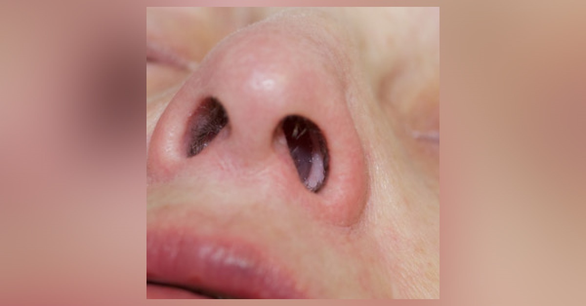 Nasal Polyposis, An Insight