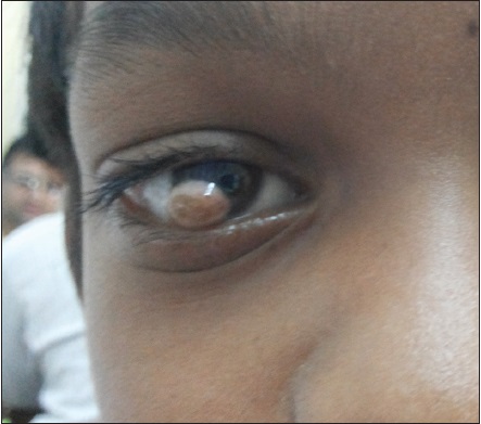 Brief Scenerio Of Goldenhars Syndrome