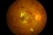 Brief Review About Diabetic Screening In Ophthalmic Complications