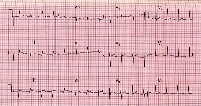 What Information Do You Get From This ECG?