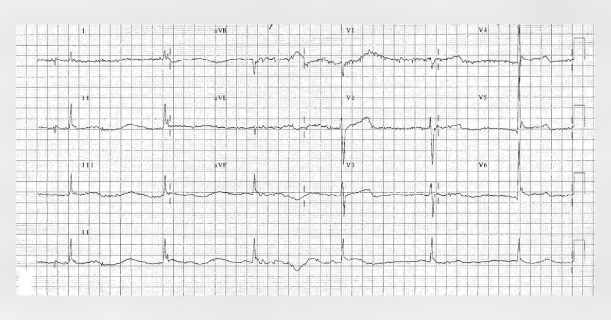 Interpret This ECG