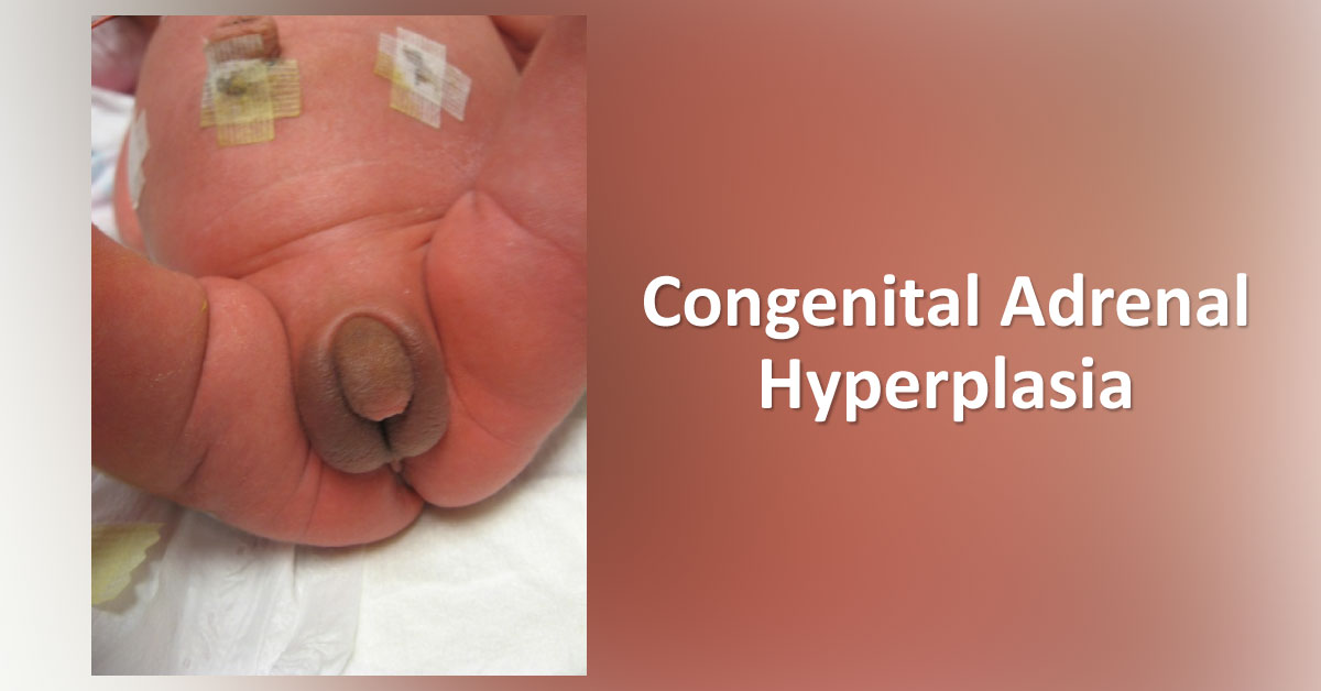 Congenital Adrenal Hyperplasia: Clinical Practice Recommendations