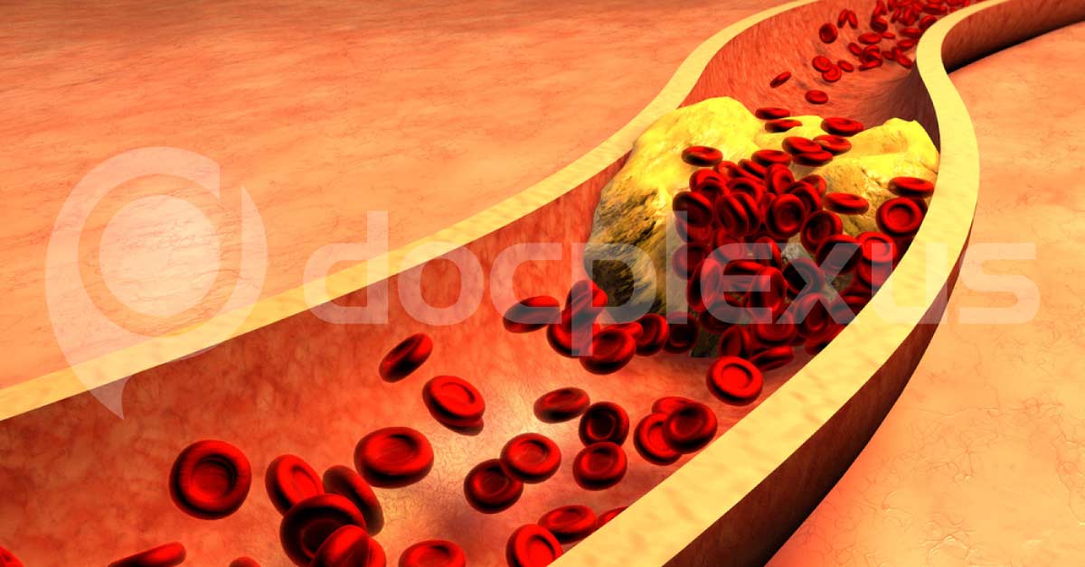 Bacteria And Not Dietary Fats, Are Risk Factors For Heart Attack
