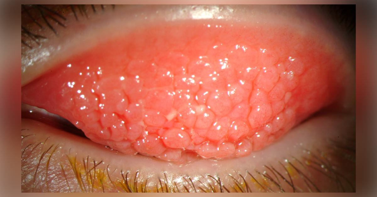 Corneal Manifestations Of Vernal Keraoconjuctivits