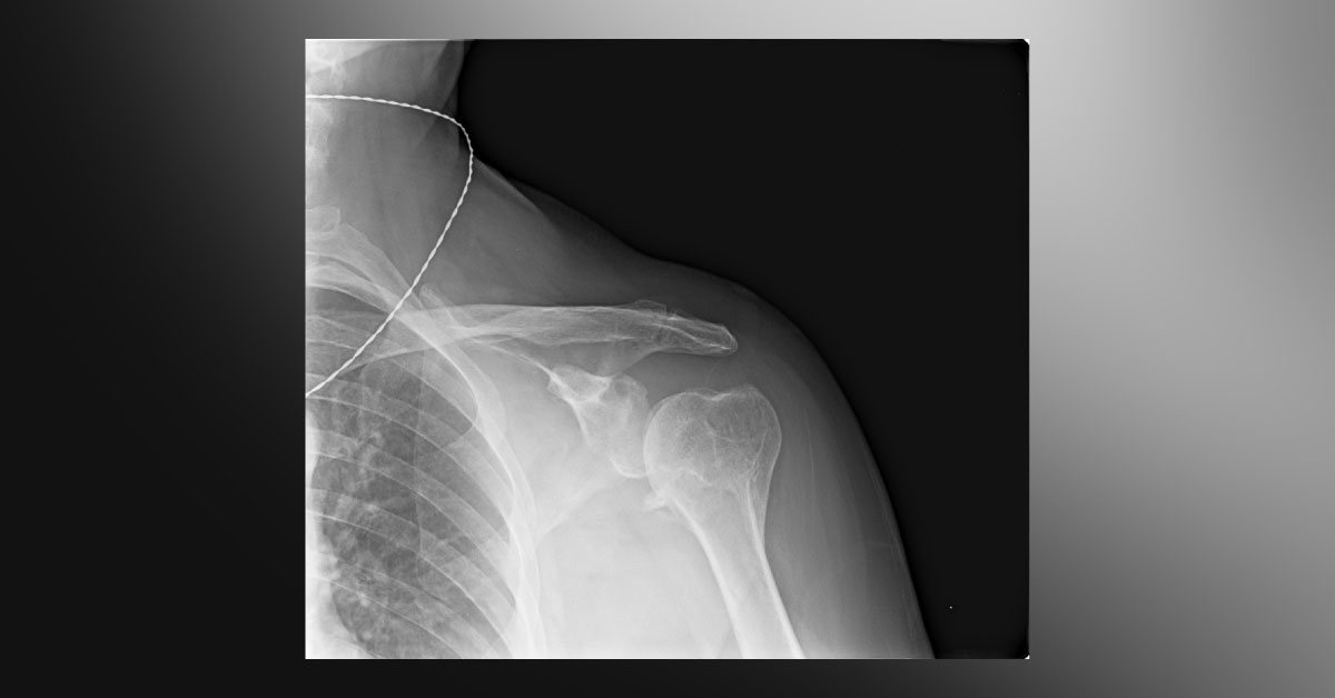 How Will You Manage This Shoulder Pain?