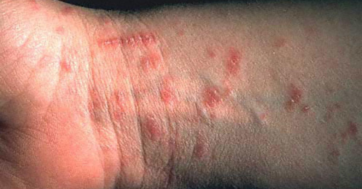 Identify The Dermal Condition