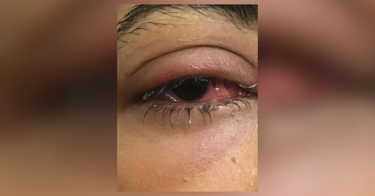 Identify This Eye Condition