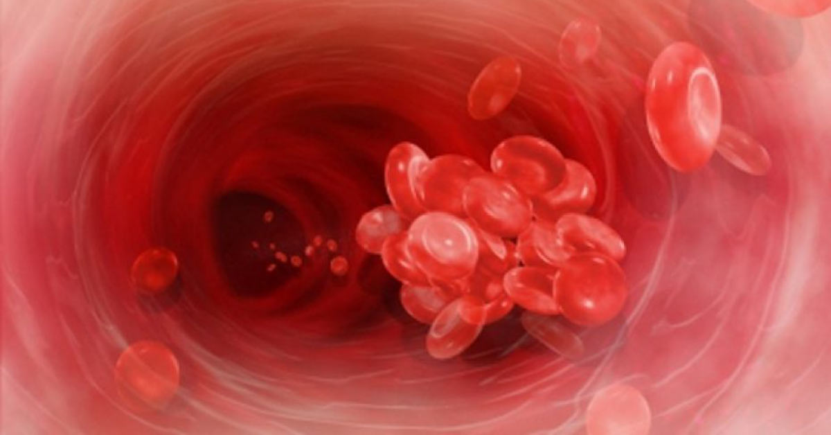 Therapeutic Fibrinolysis - Indications & Timings