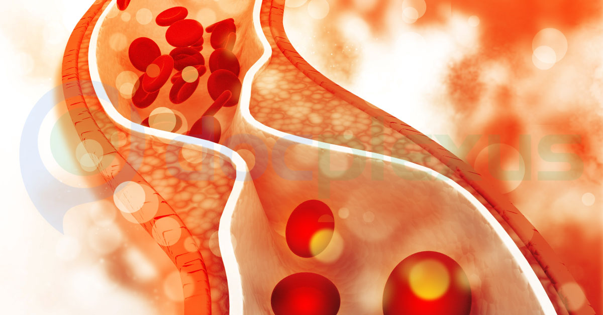 A Case Of Pulmonary Embolism