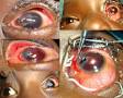Penetrating Corneal Injuries In Paediatric Age Group By Domestic Birds