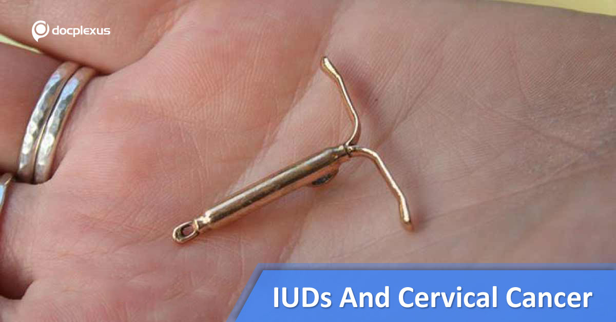 IUDs And Reduced Risk Of Cervical Cancer