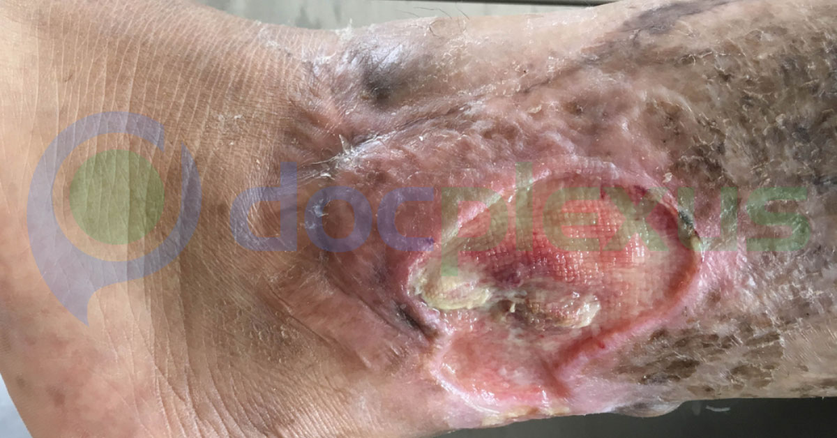 Low Dose Aspirin Can Treat Venous Ulcers On Extremity