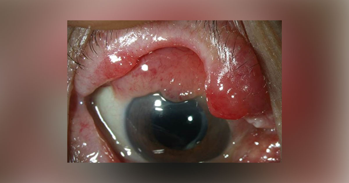 Ocular Manifestations Of Leukemia Brief Review
