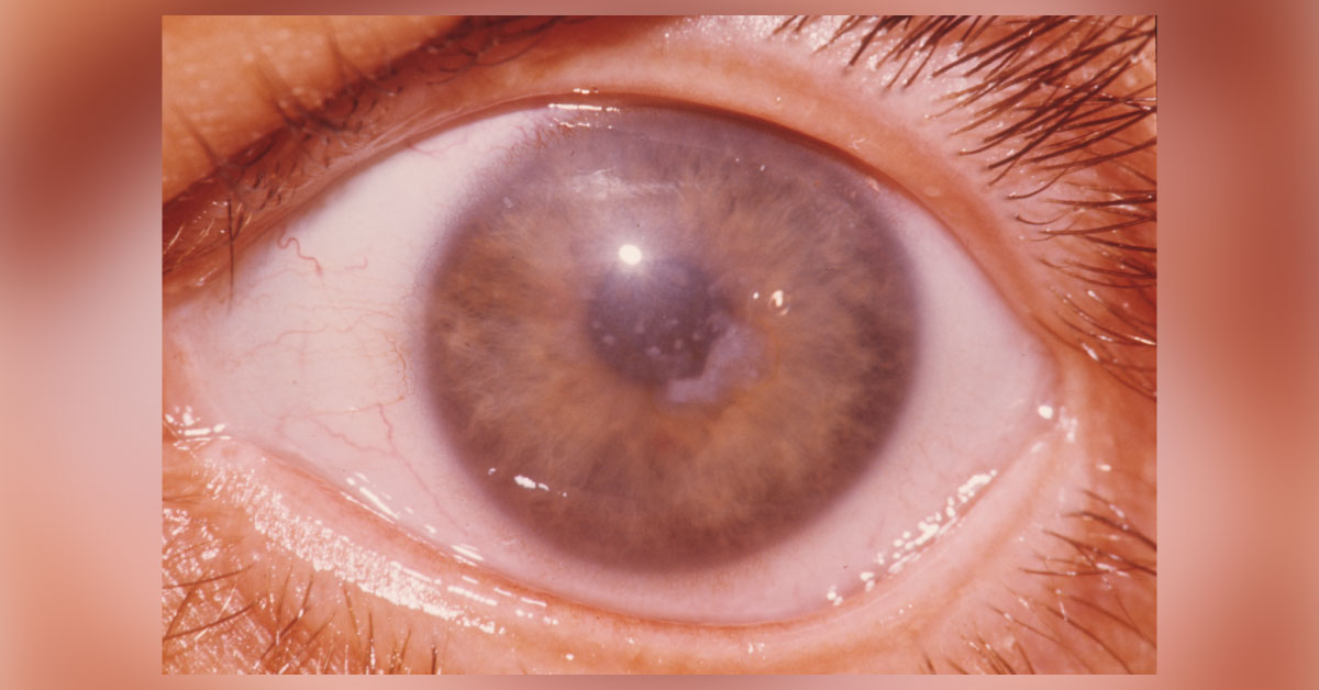 A Brief Scenerio Of Corneal Dystrophy