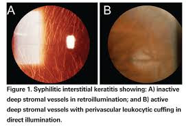 Ocular Manifestations Of Syphilis, HIV Type 1 Infected Host