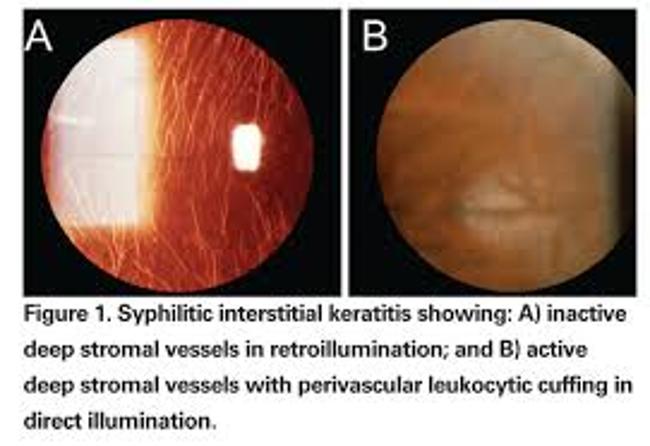 Syphilis Host Docplexus