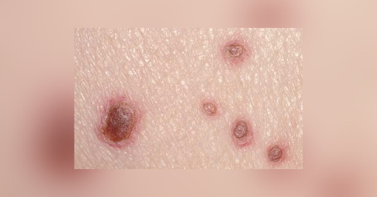 What Can Be The Cause Of These Papules?