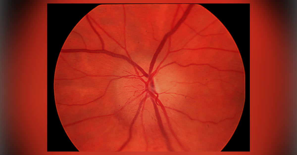 Differential Diagnosis Of Papilledema Papillitis And Retrobulbar Neuritis