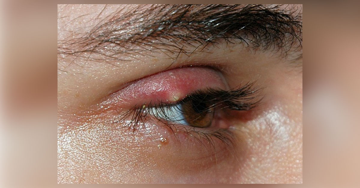 Identify This Eye Disease
