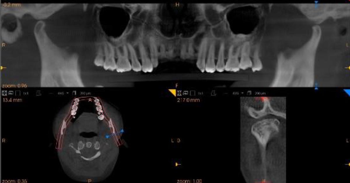 A TMJ Problem