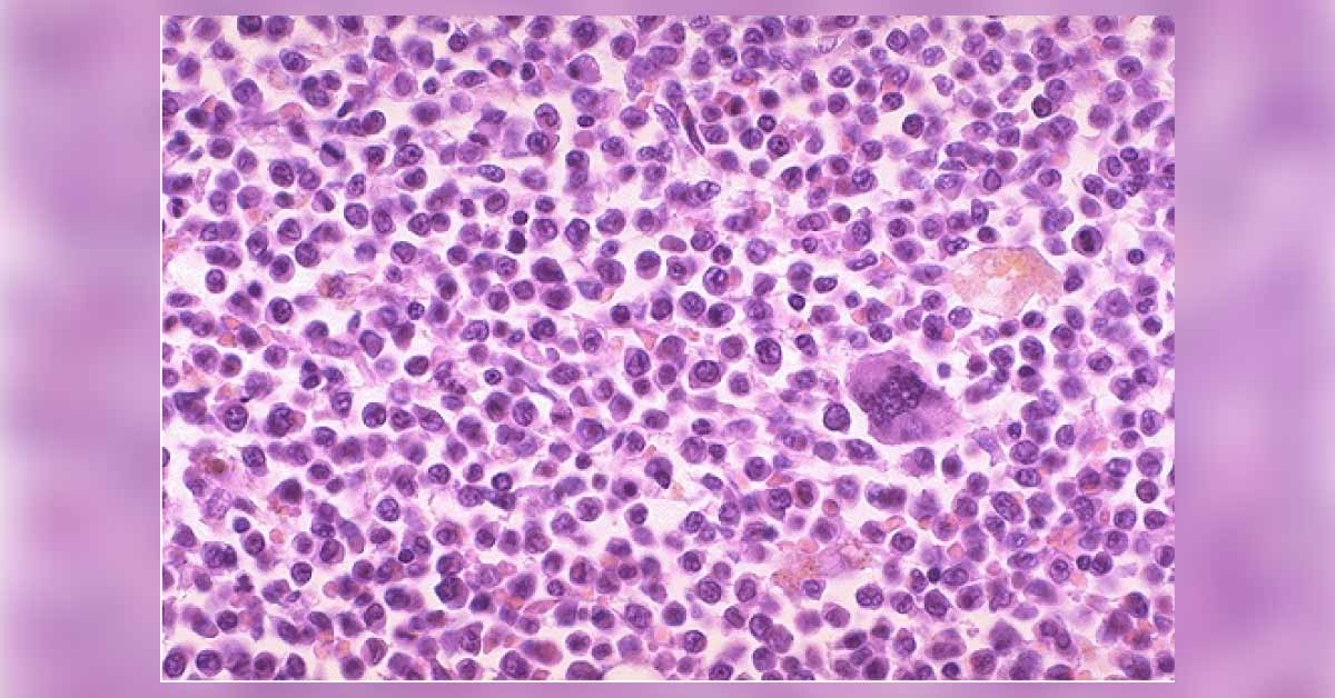 What Is This Hematology Condition?