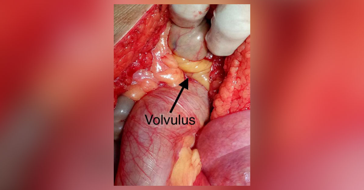 Case Of Sigmoid Colon Volvulus