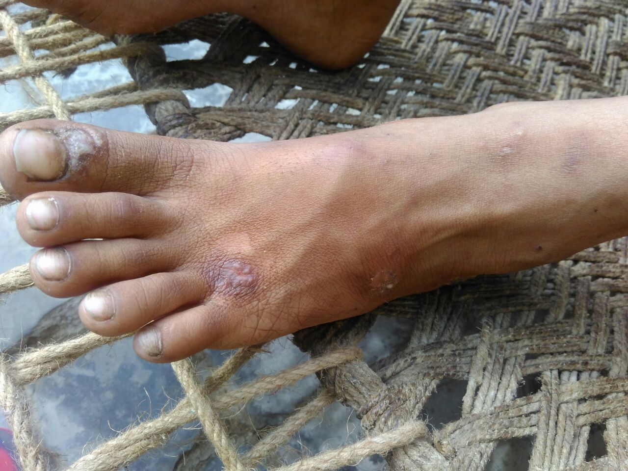 Skin Infection On Both Foot From Last 6 Month