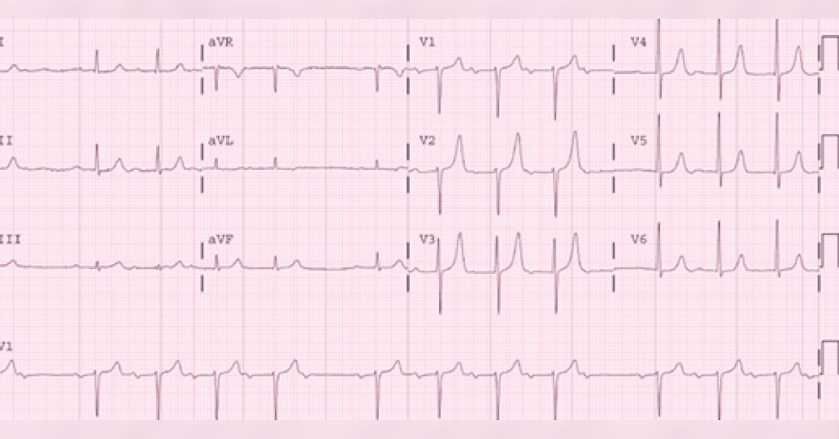 Interpret This ECG