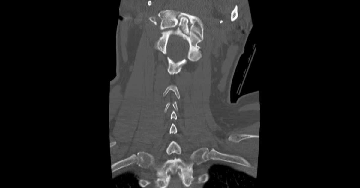 Recommend The Best Treatment For This Fracture