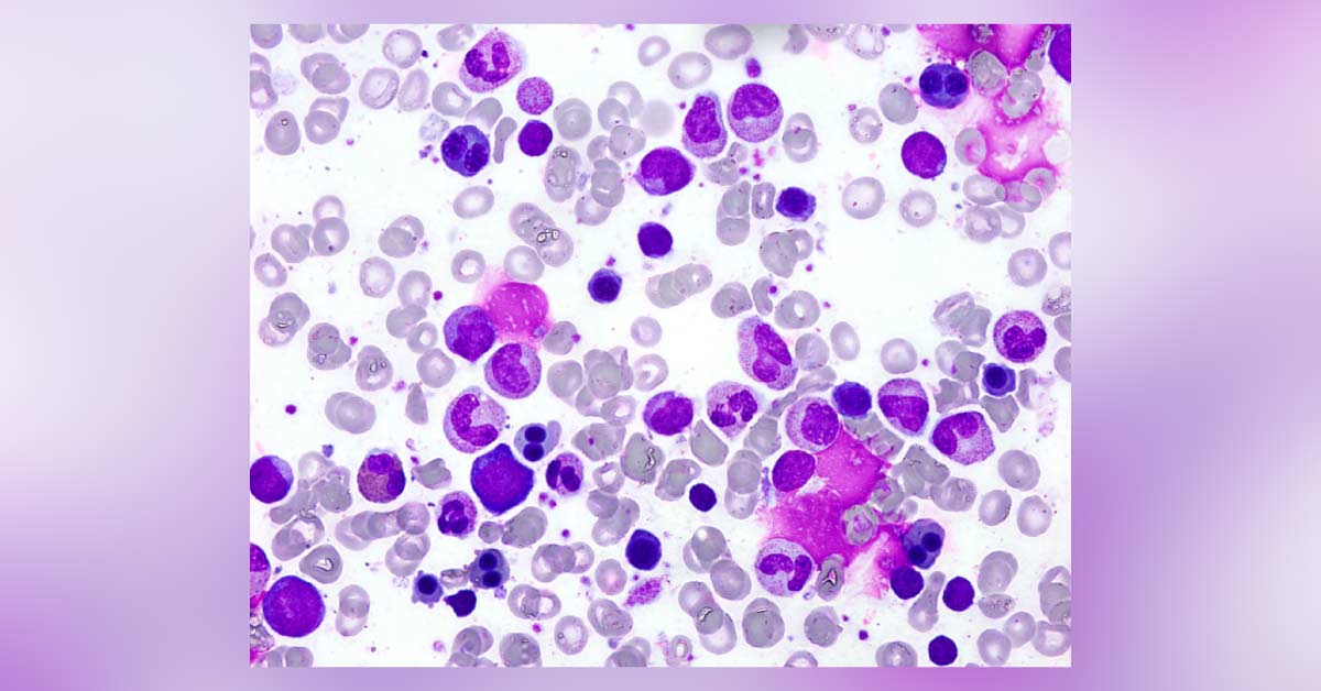 Premature Infant With Unexplained Anemia