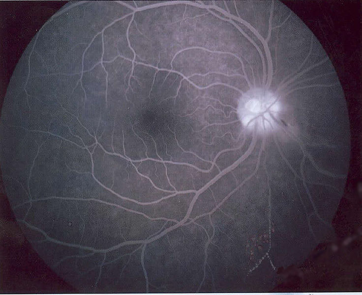 A Brief Review Of  Flouresence In Ophthalmology